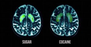 Utocaj kokain i šećer na mozak, magnetna rezonanca (1)